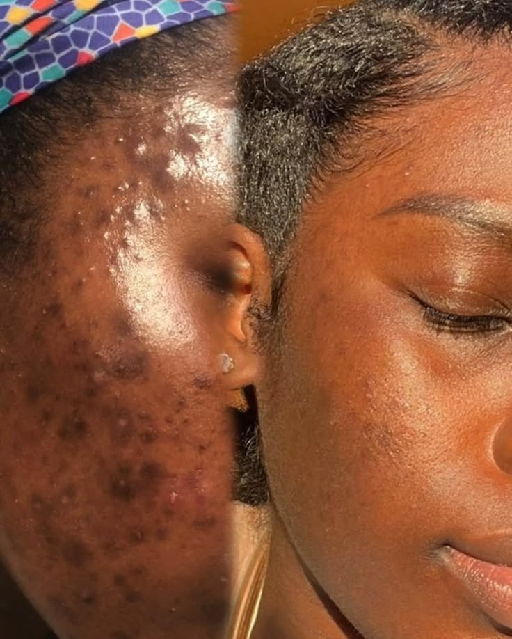 Acne Reduction Facial in Georgetown, Guyana