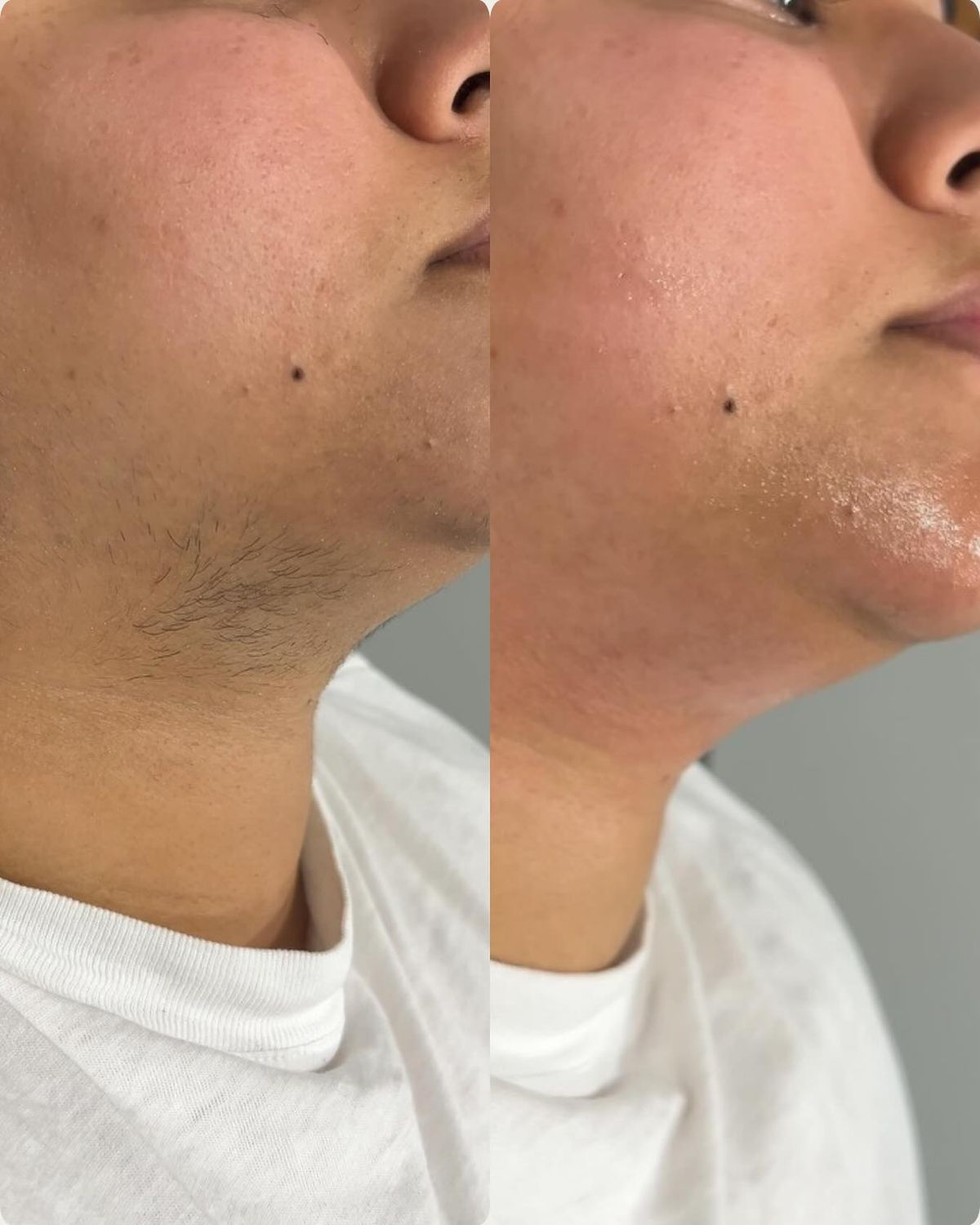 Chin Wax at Ultimate Renew Spa in Georgetown, Guyana