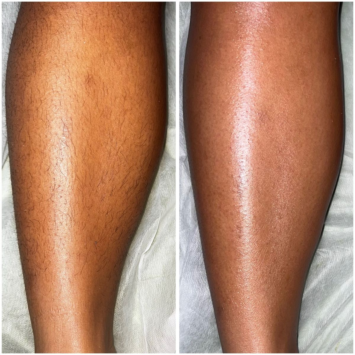 Full Legs Wax at Ultimate Renew Spa in Georgetown, Guyana