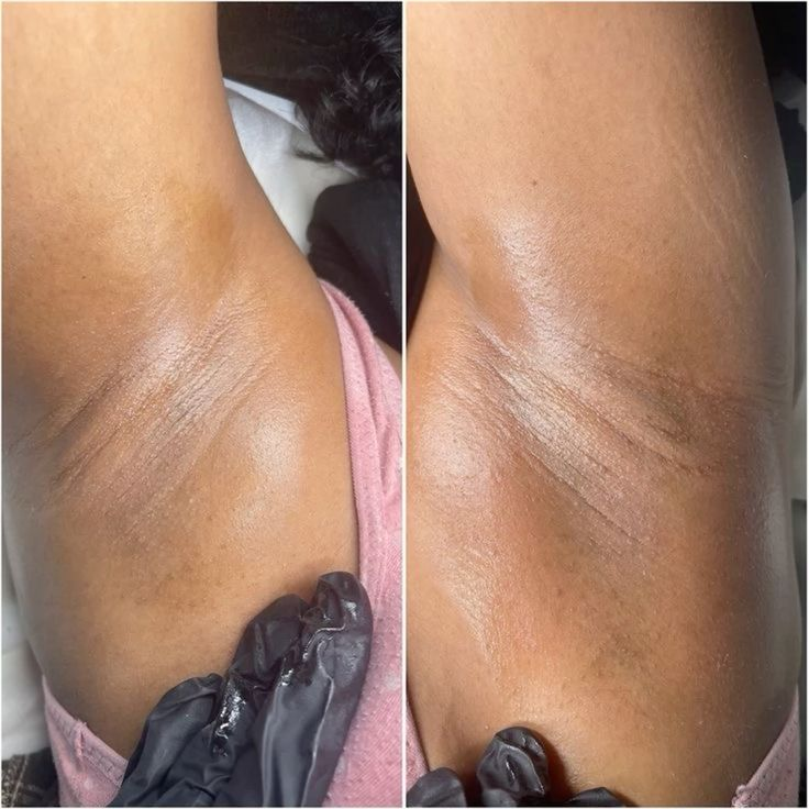 Underarm Wax at Ultimate Renew Spa in Georgetown, Guyana